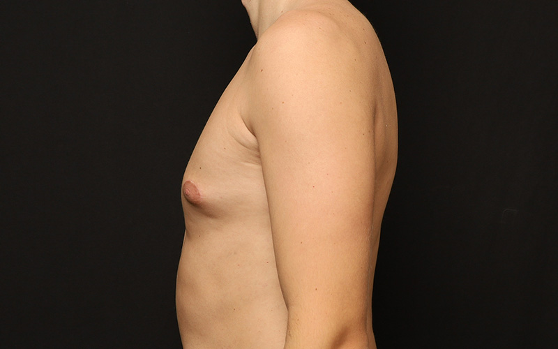 Gynecomastia Before and After 01