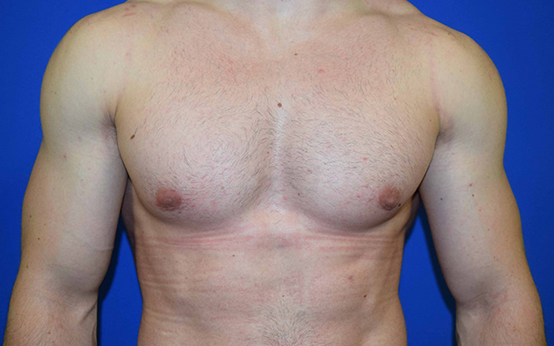 Gynecomastia Before and After 01
