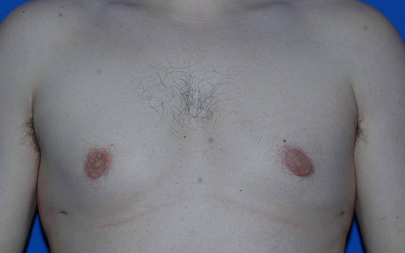 Gynecomastia Before and After 01