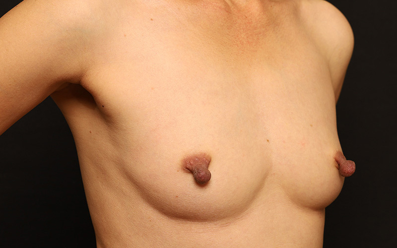 Nipple Reduction Before and After 01