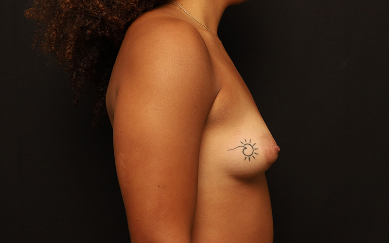 Nipple Reduction Before and After 05