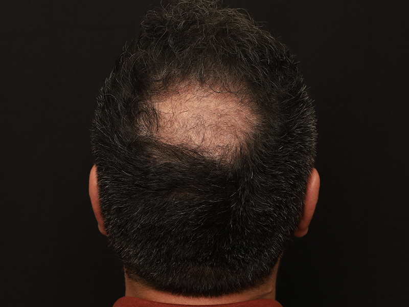 Hair Restoration Before and After 04