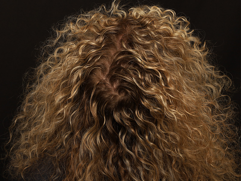 Hair Restoration Before and After 04