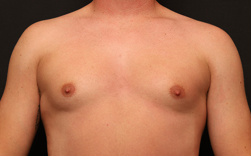 Male Gynecomastia Before and After 01
