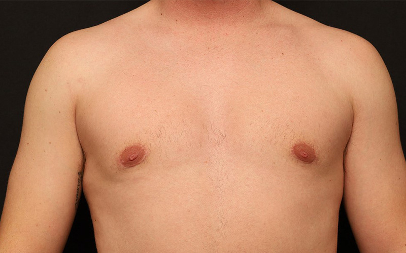 Male Gynecomastia Before and After 01