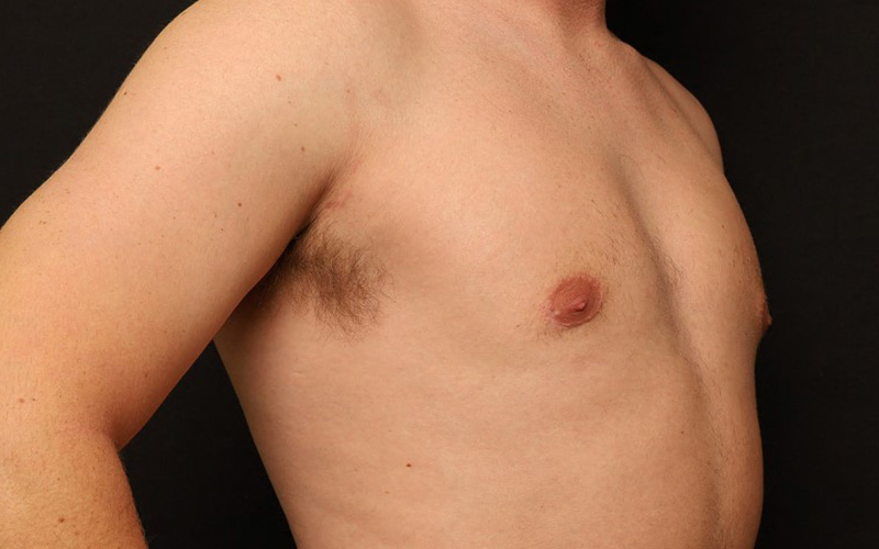Male Gynecomastia Before and After 01