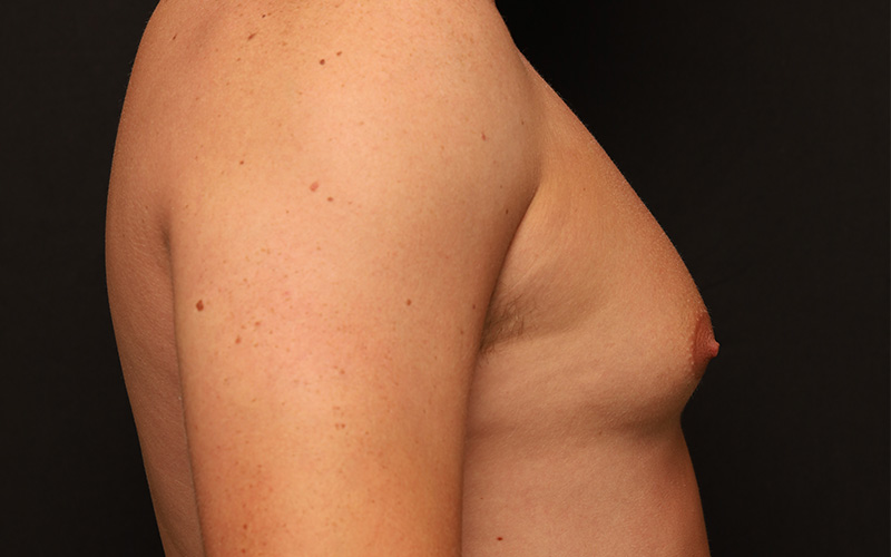 Male Gynecomastia Before and After 01