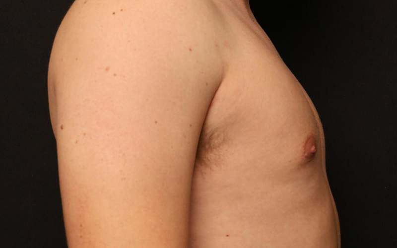 Male Gynecomastia Before and After 01