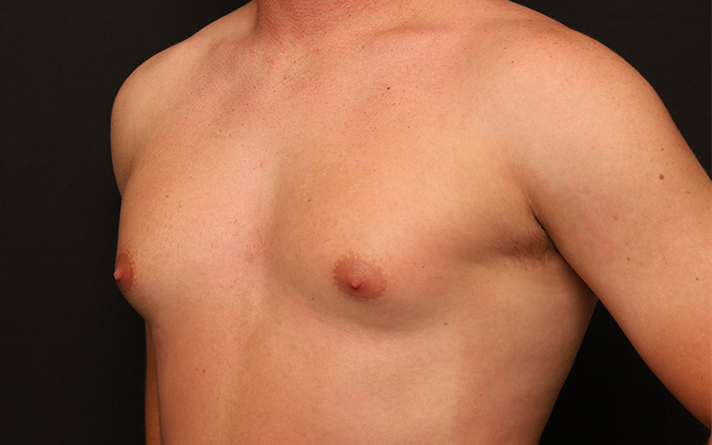 Male Gynecomastia Before and After 01
