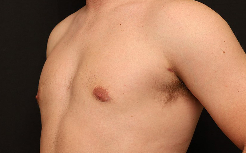 Male Gynecomastia Before and After 01