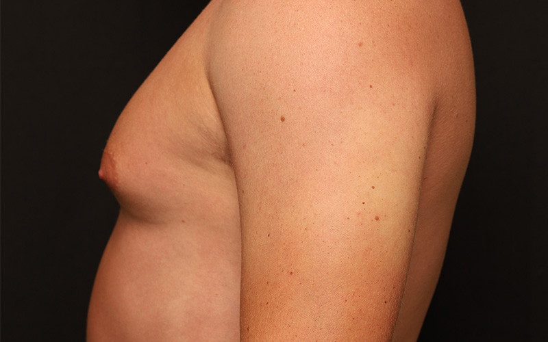 Male Gynecomastia Before and After 01