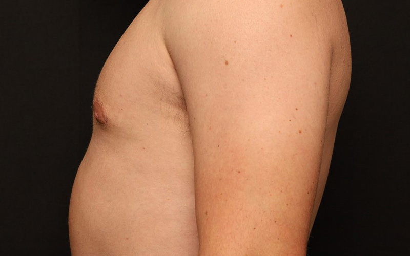 Male Gynecomastia Before and After 01