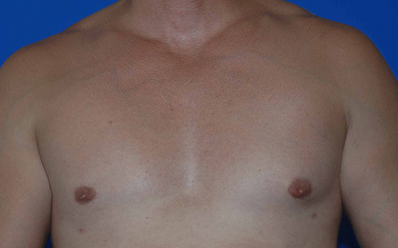 Male Gynecomastia Before and After 01