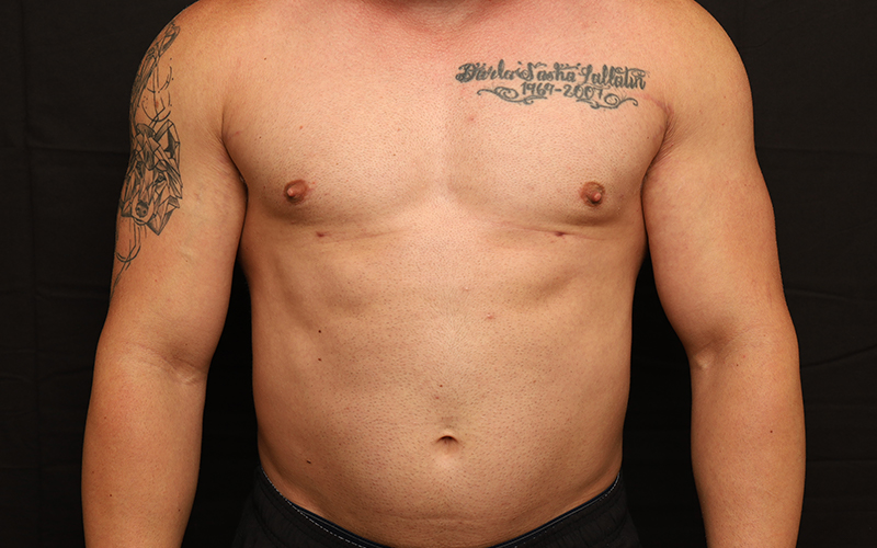 Male Gynecomastia Before and After 01