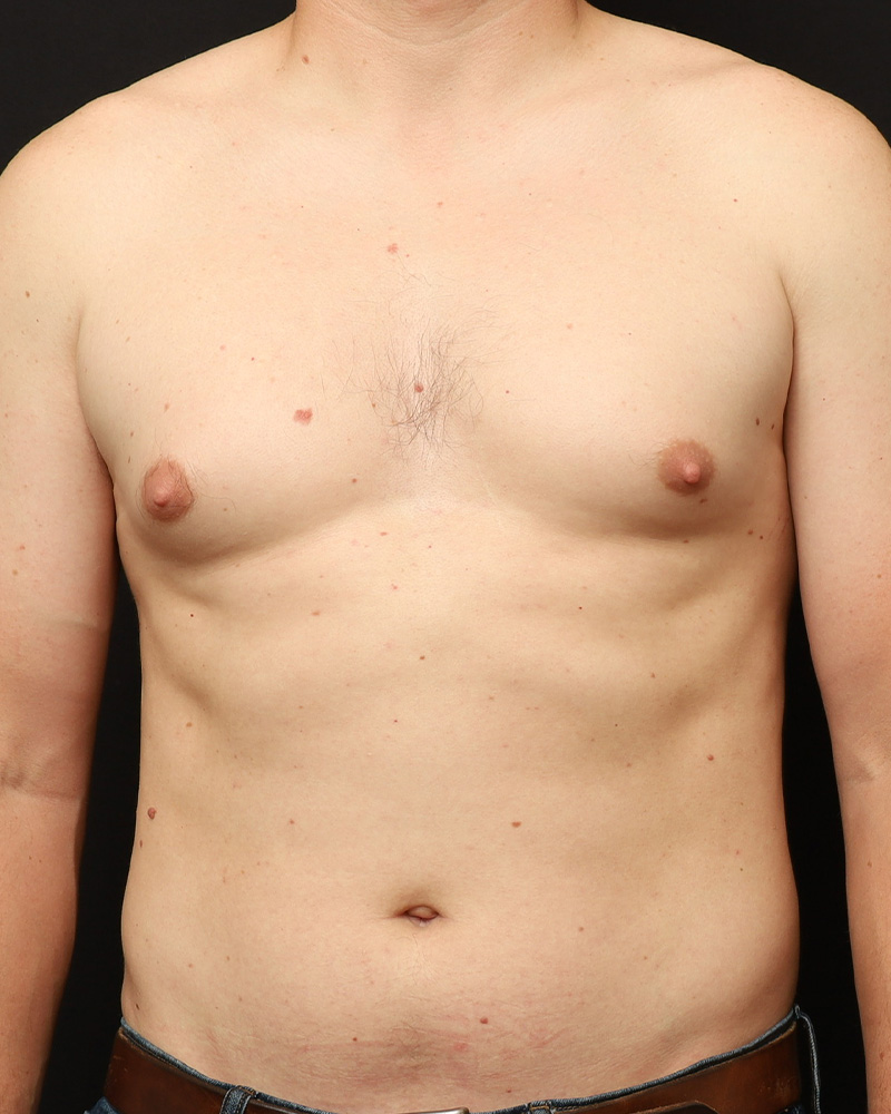 Male Liposuction Before and After 01