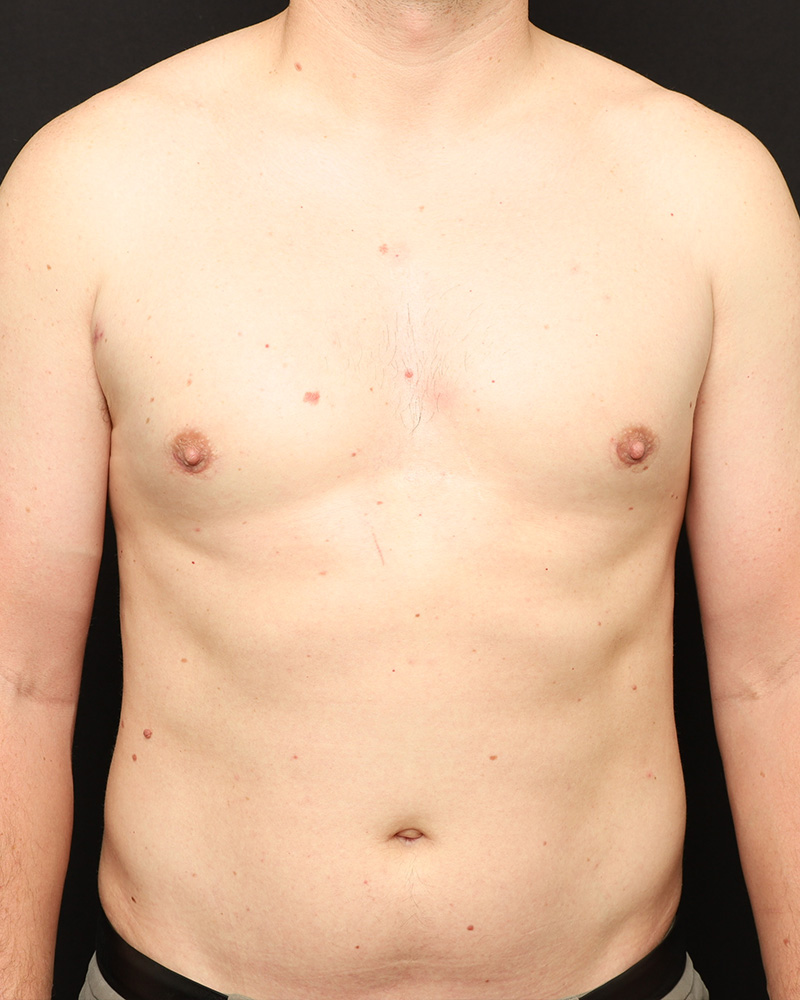 Male Liposuction Before and After 01
