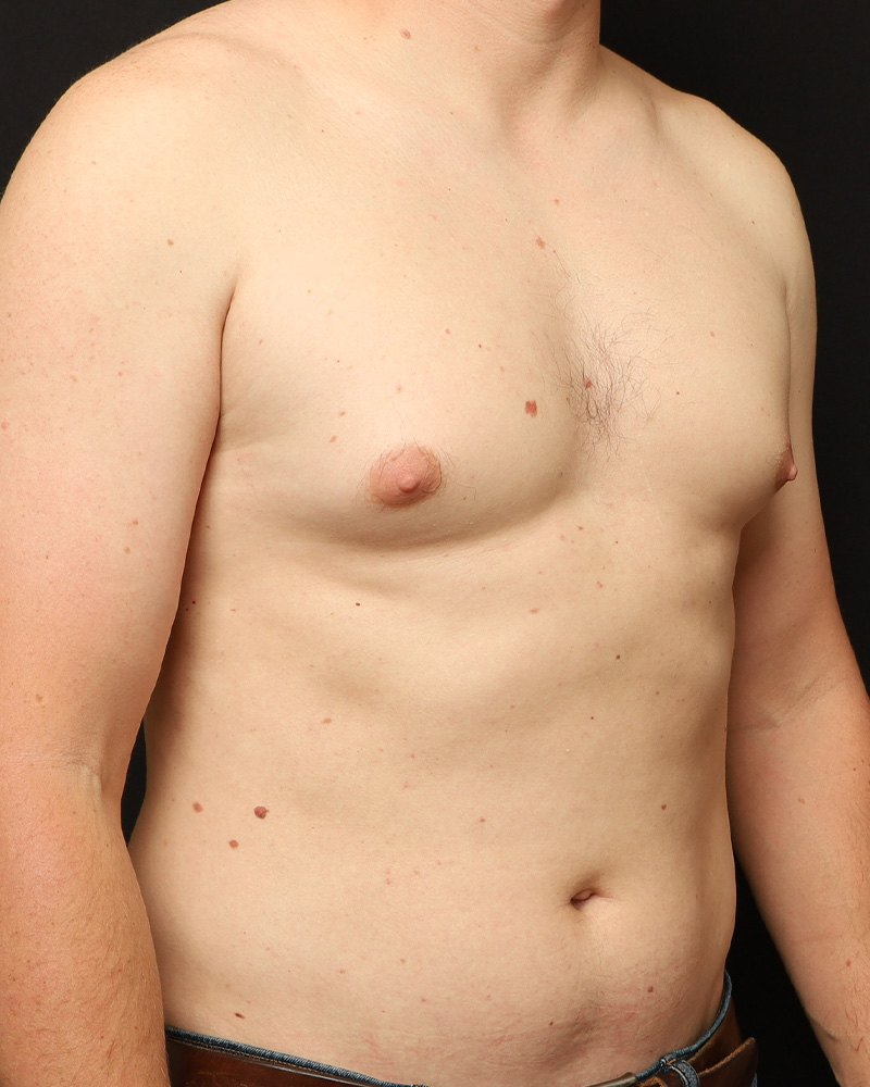 Male Liposuction Before and After 01