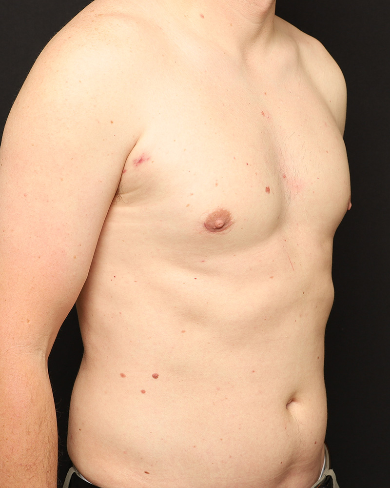 Male Liposuction Before and After 01