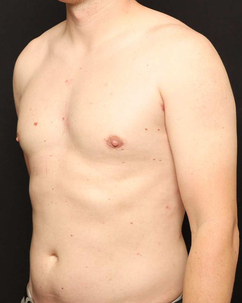 Male Liposuction Before and After 01