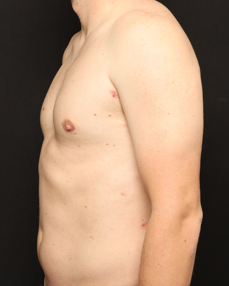 Male Liposuction Before and After 01