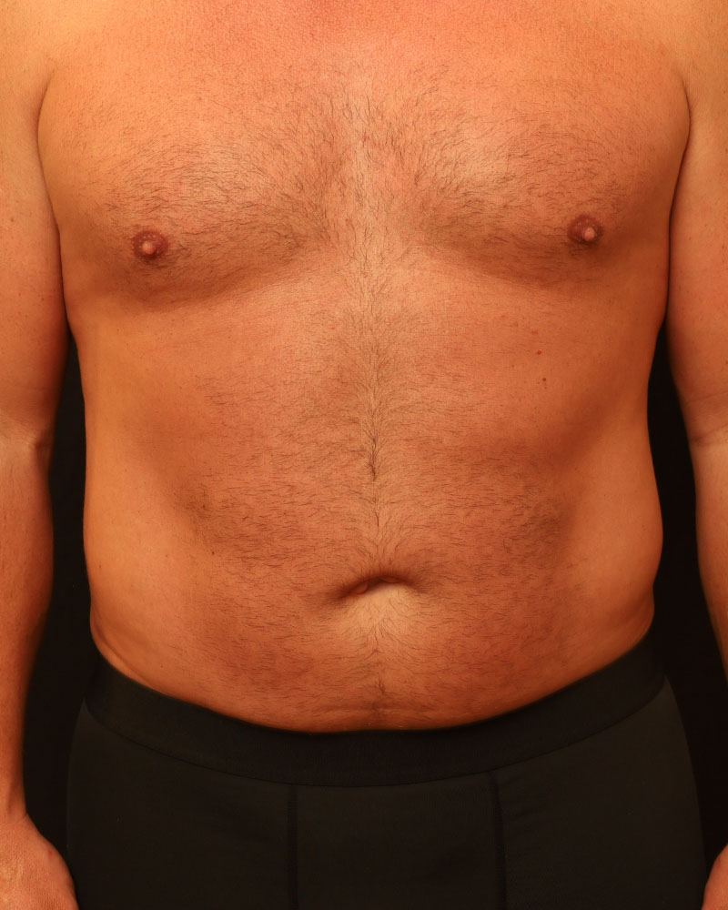 Male Liposuction Before and After 01