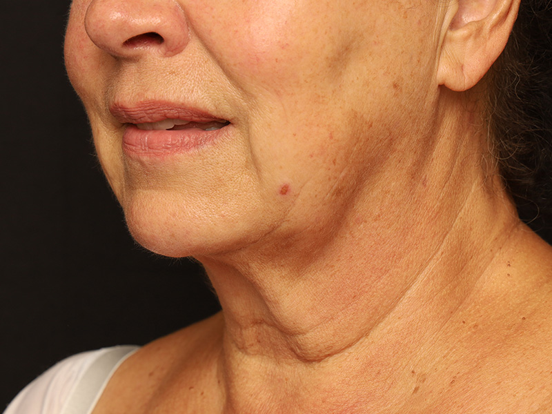 Acutite Before and After 01