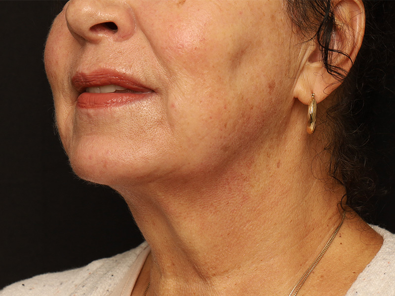 Acutite Before and After 01