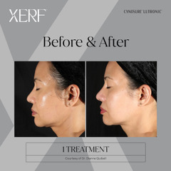 Before & After XERF Structural Skin Tightening