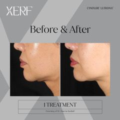 Before & After XERF Structural Skin Tightening