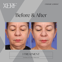 Before & After XERF Structural Skin Tightening