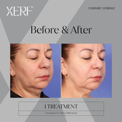 Before & After XERF Structural Skin Tightening